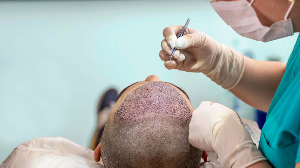 How Hair Is Inserted in Hair Transplant Surgery ? Hair Transplant