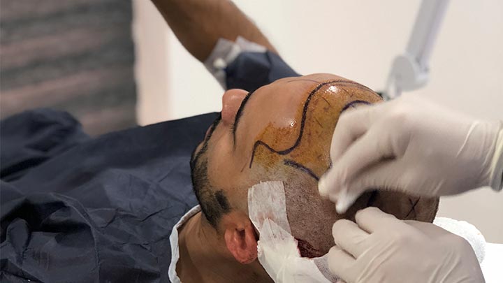 Follicular unit extraction (FUE) fue