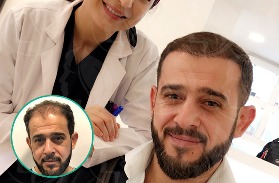 Do you have a hair loss that bothers you?
