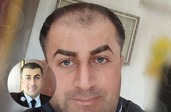 Do you have a hair loss that bothers you?