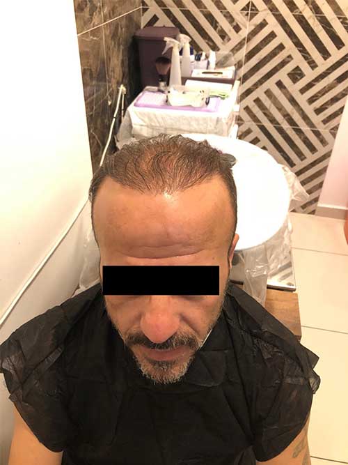 Who can get a hair transplant? hair transplant