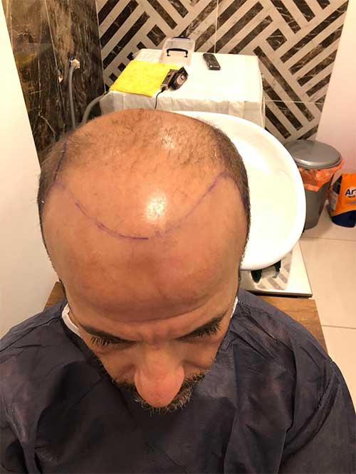 Who can get a hair transplant? hair transplant