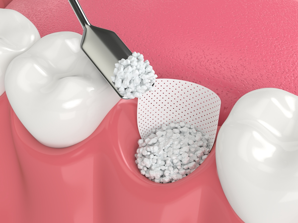 Gum Tissue Grafts