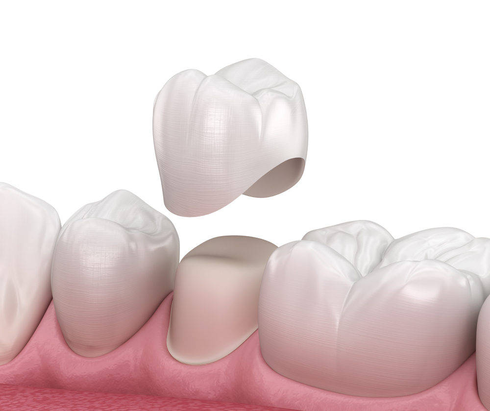 Everything About Getting a Dental Crown Dental Crown