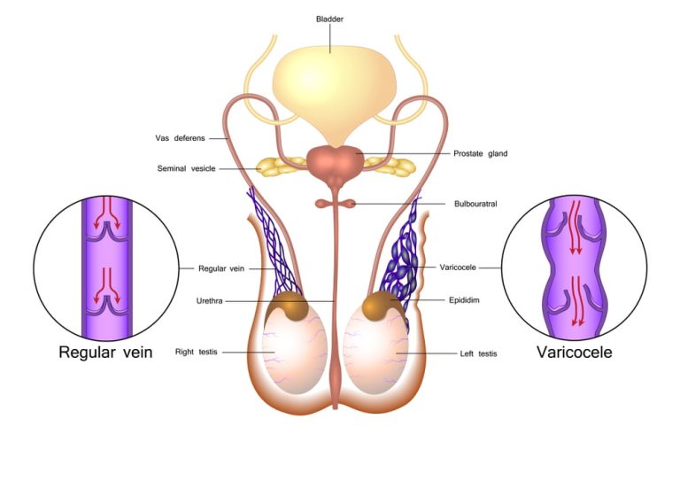 Varicocele treatment Varicocele treatment