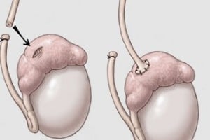 Vasectomy reversal surgery Vasectomy reversal surgery