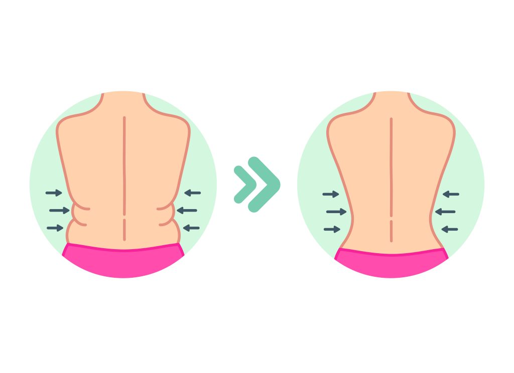 What Is a Back Lift? What Is a Back Lift?