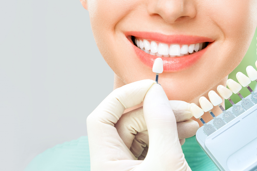 Hollywood Smile