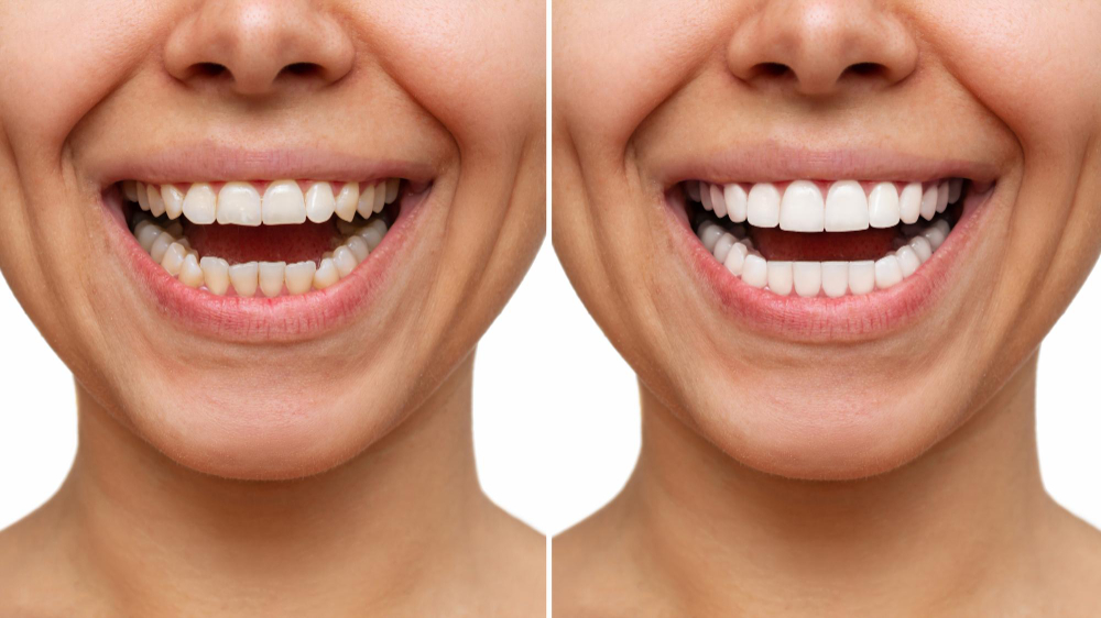 Hollywood Smile