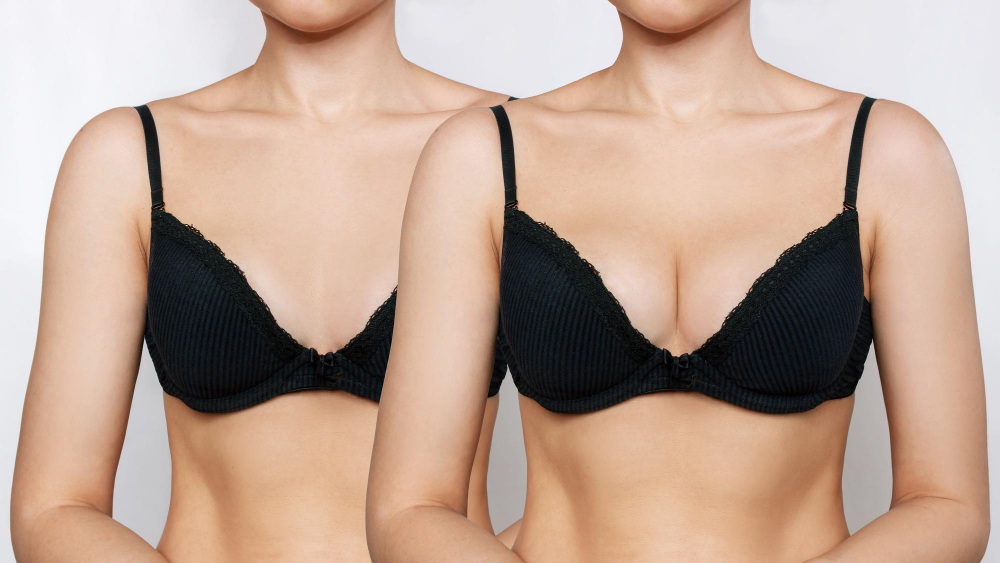 What is Breast implants Surgery? What is Breast implants Surgery?