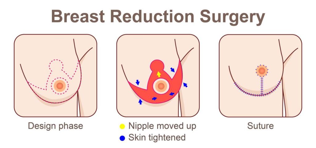 Breast Reduction Breast Reduction