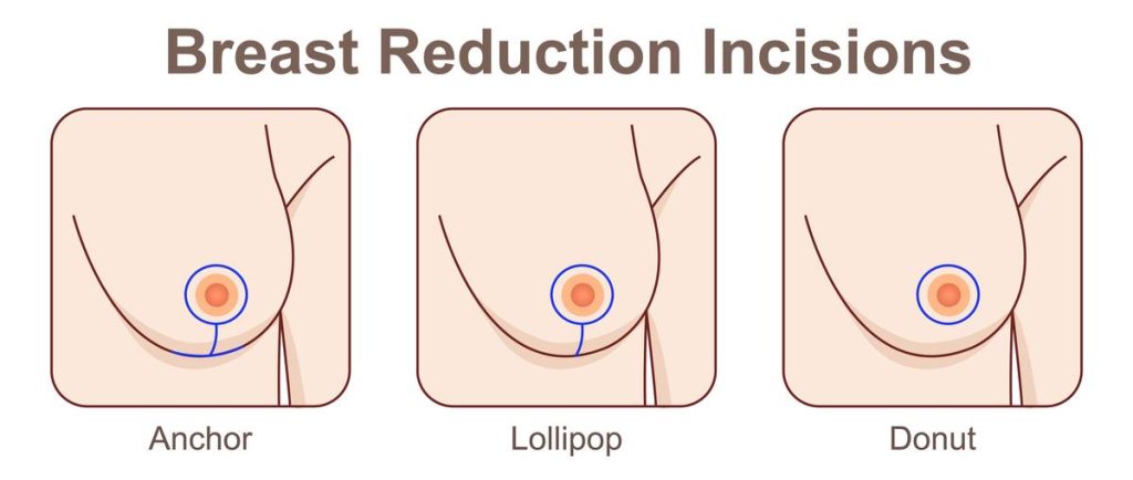 Breast Reduction Breast Reduction