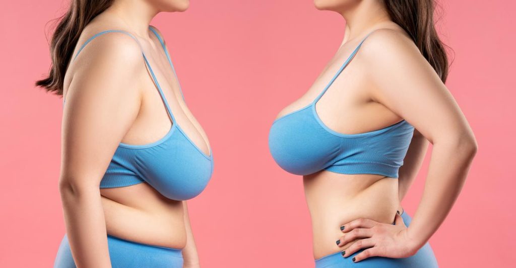 Breast Reduction Breast Reduction