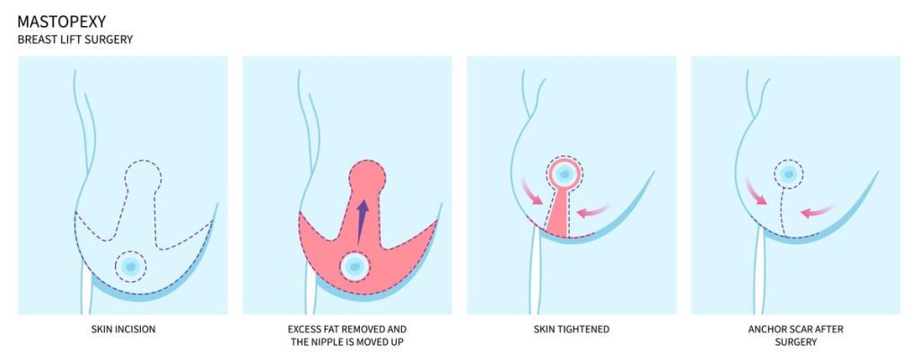 Breast Reduction Breast Reduction