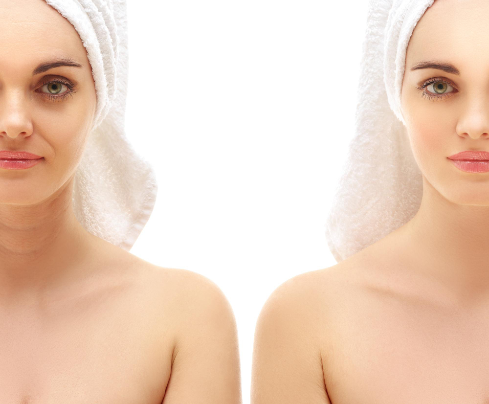 Neck Lift Neck Lift