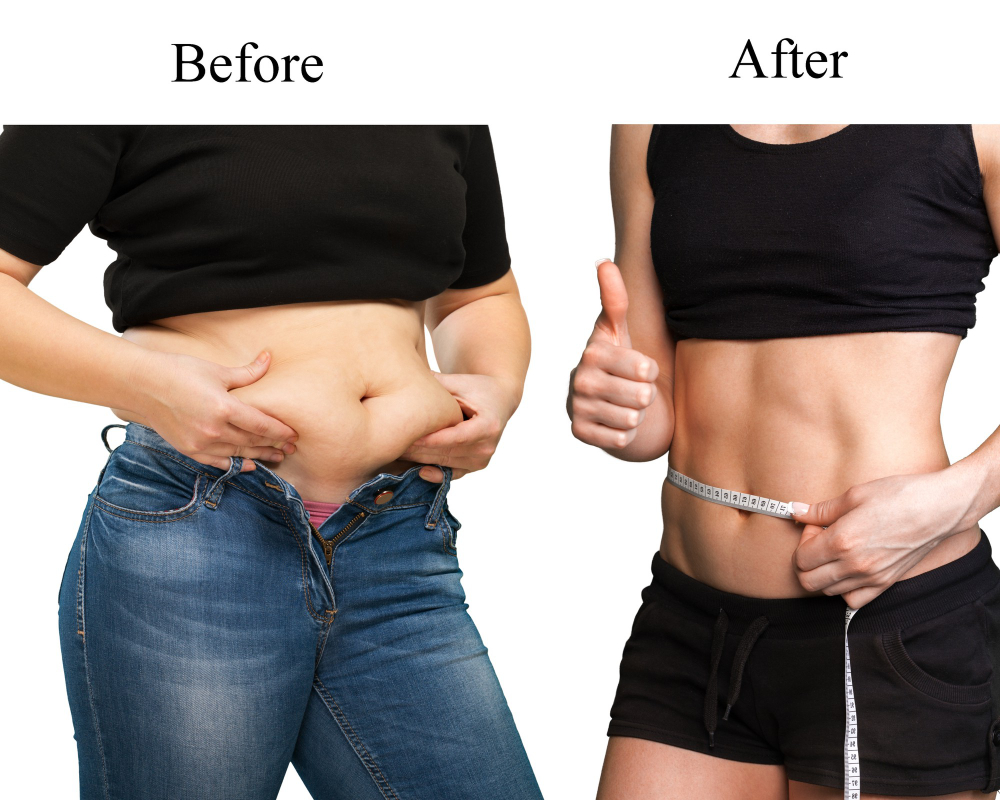 Tummy Tuck Surgery (Abdominoplasty) Tummy Tuck Surgery (Abdominoplasty)