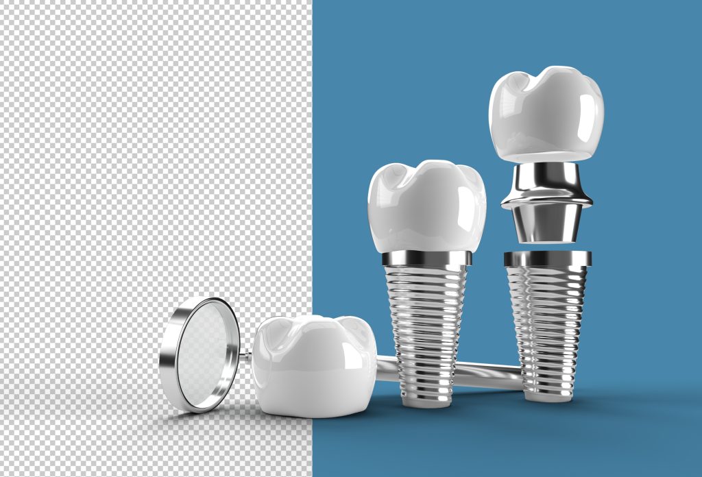 Dental Implants The Complete Guide Dental Implants The Complete Guide