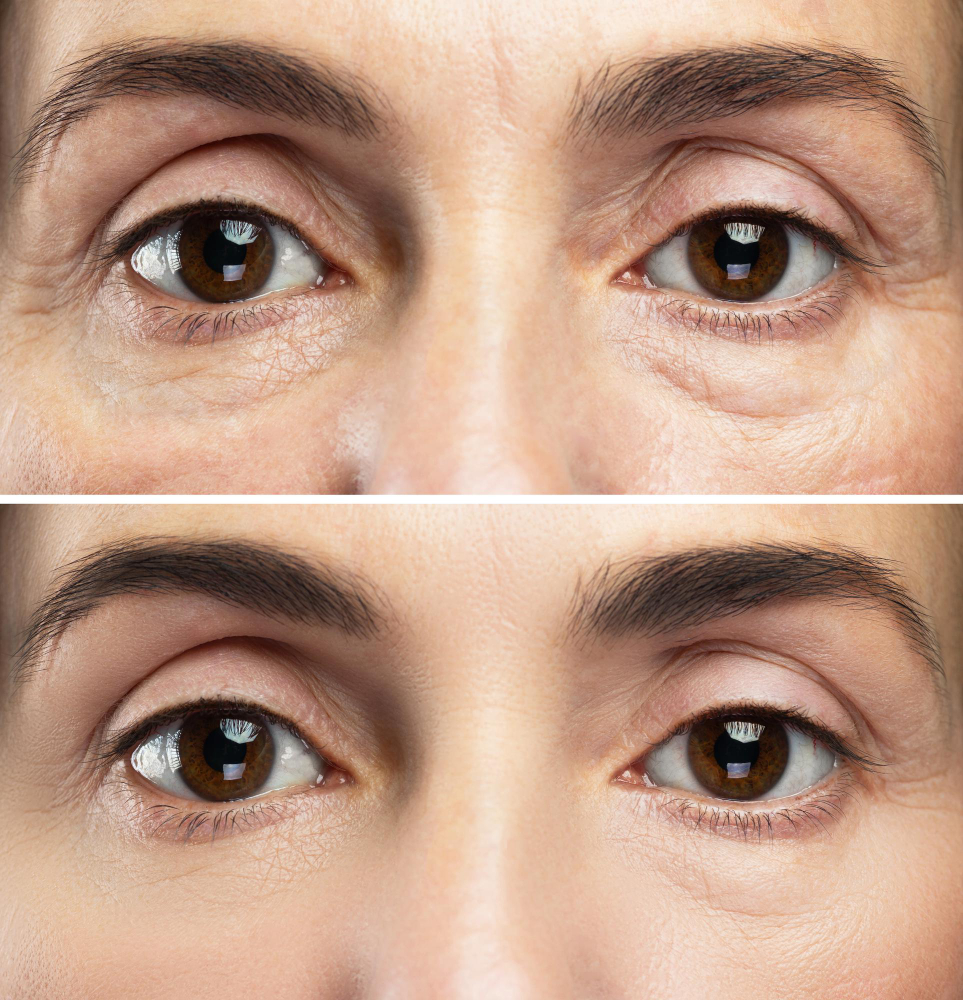 Blepharoplasty