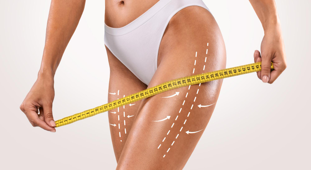 Thighplasty (Thigh Lift) Thighplasty (Thigh Lift)