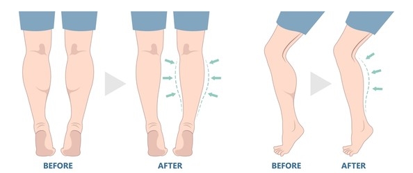 Calf Implants Calf Implants
