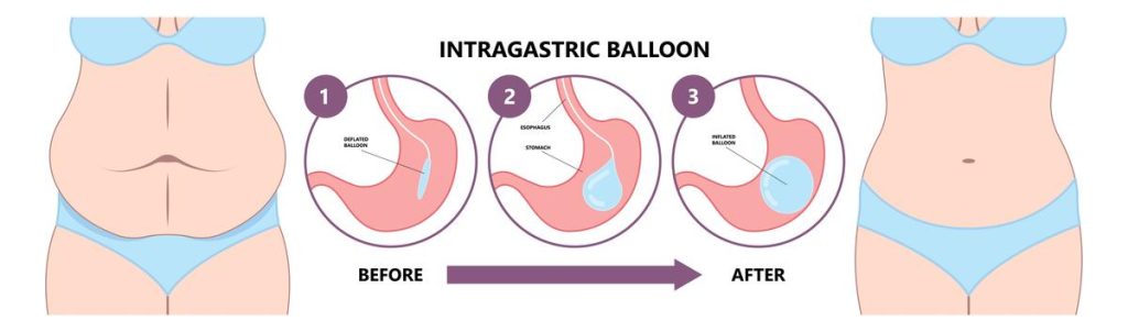 What is Laparoscopic adjustable gastric banding (LAGB)? What is Laparoscopic adjustable gastric banding (LAGB)?