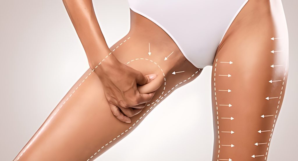 Thighplasty (Thigh Lift) Thighplasty (Thigh Lift)