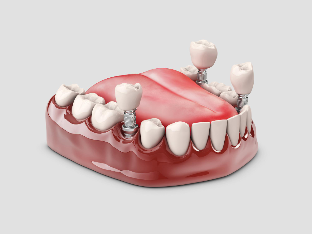Dental Implants The Complete Guide Dental Implants The Complete Guide