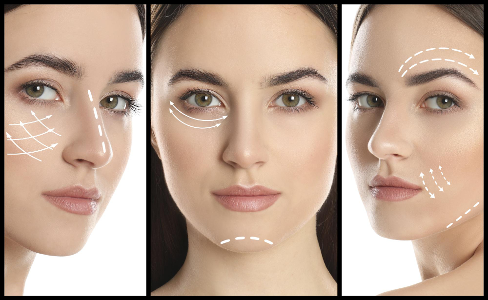 What is Mini Facelift Surgery? What is Mini Facelift Surgery?