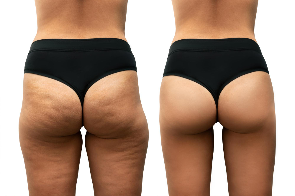 Butt Implants Butt Implants
