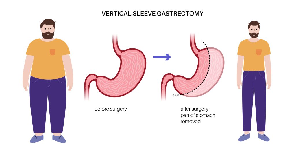 What is Sleeve Gastrectomy? The Vertical Sleeve Gastrectomy