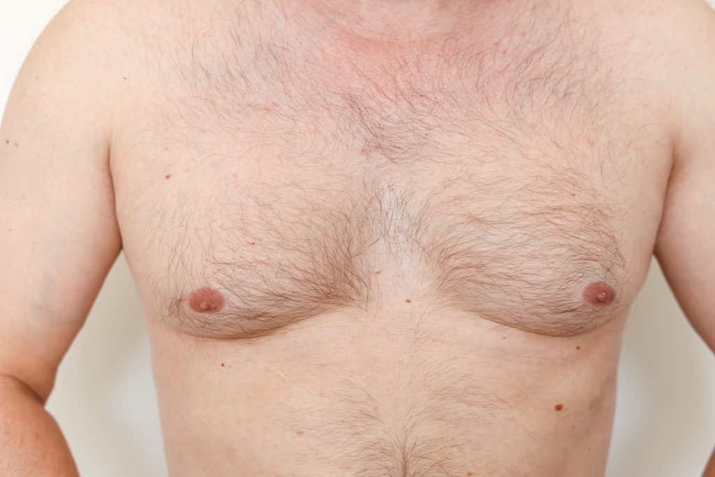 Gynecomastia surgery Gynecomastia surgery