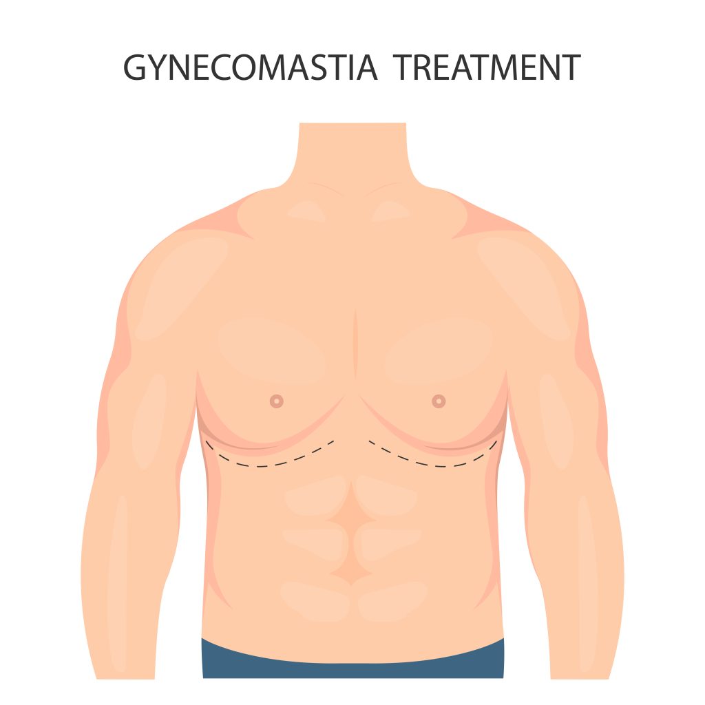 Gynecomastia surgery Gynecomastia surgery