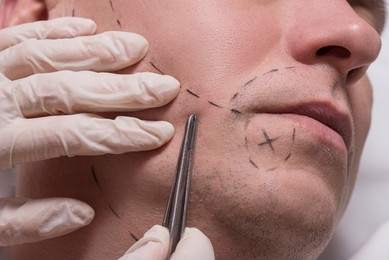 Beard Transplant (FUE VS FUT) Beard Transplant