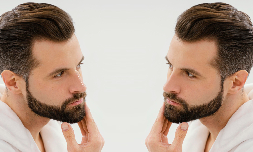 Beard Transplant (FUE VS FUT) Beard Transplant