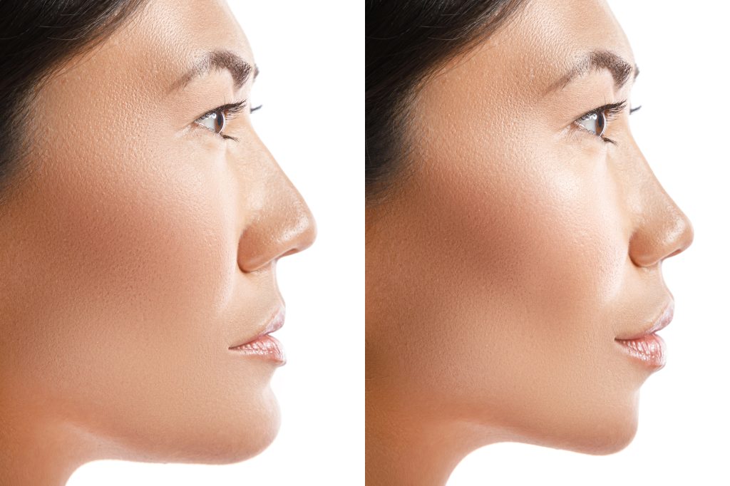 Facial Implants Facial Implants