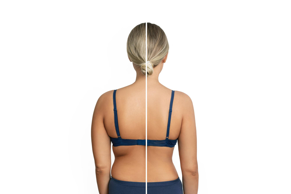 Back Lift, Recovery & Types Back Lift, Recovery & Types