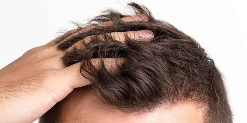 What is a FUE hair transplant? What is a FUE hair transplant?
