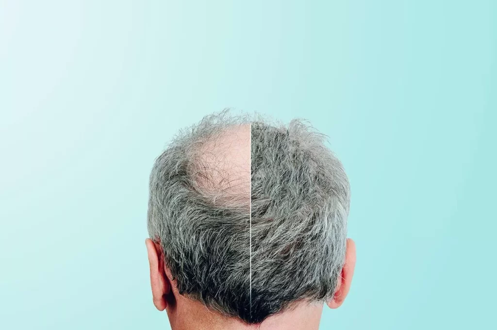What is a FUE hair transplant? What is a FUE hair transplant?