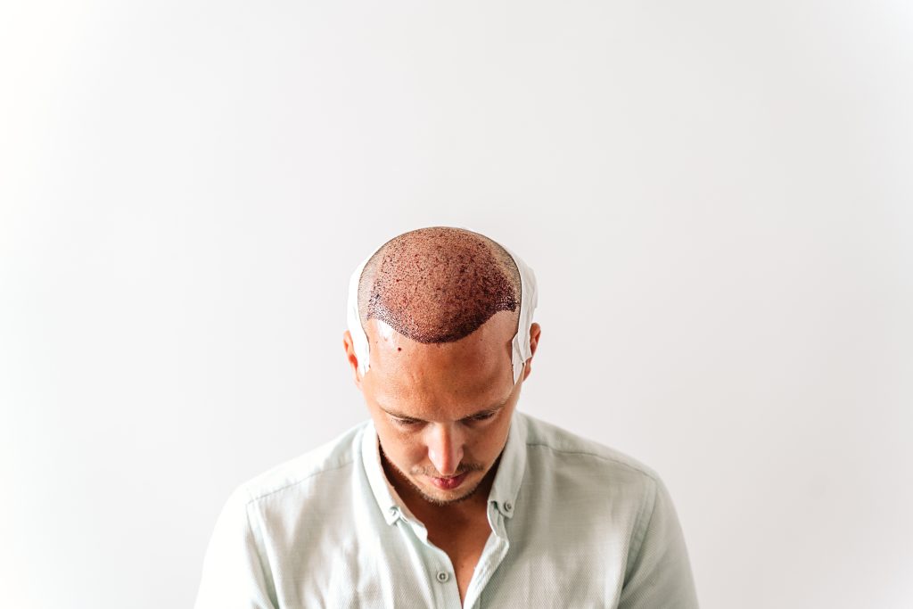 Hair Transplant Aftercare Instructions DHI Hair Transplant