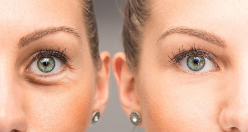 Droopy Eyelid Droopy Eyelid