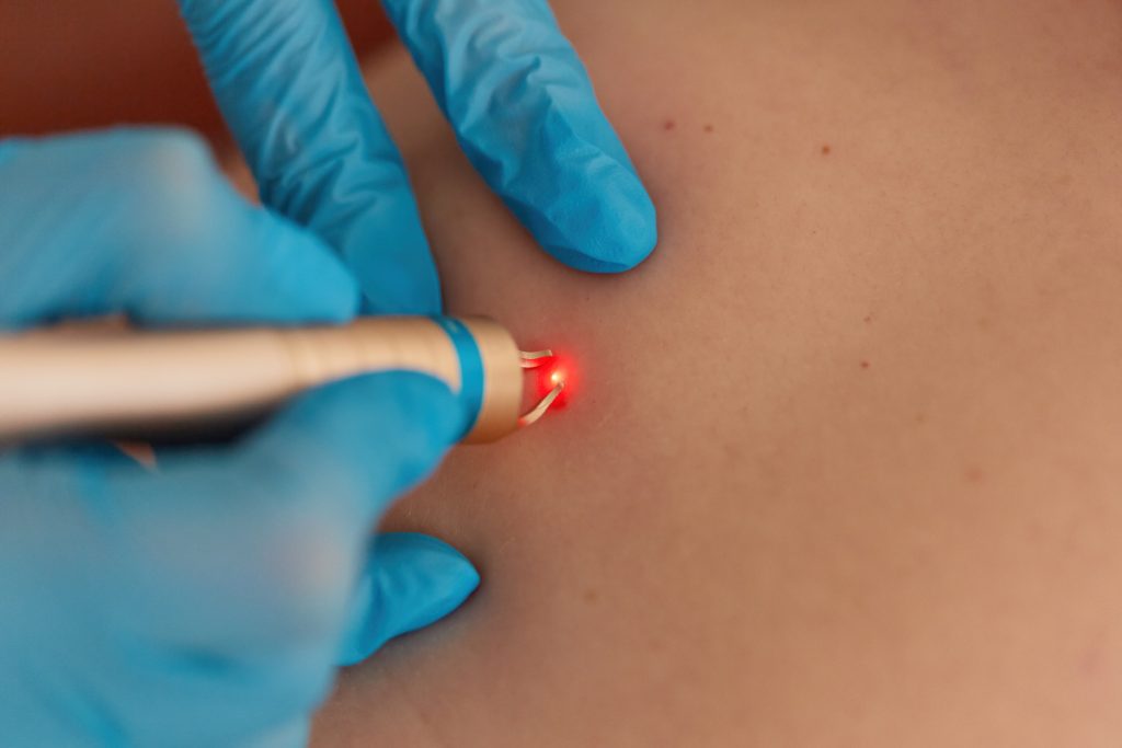 Scar Revision Scar Revision