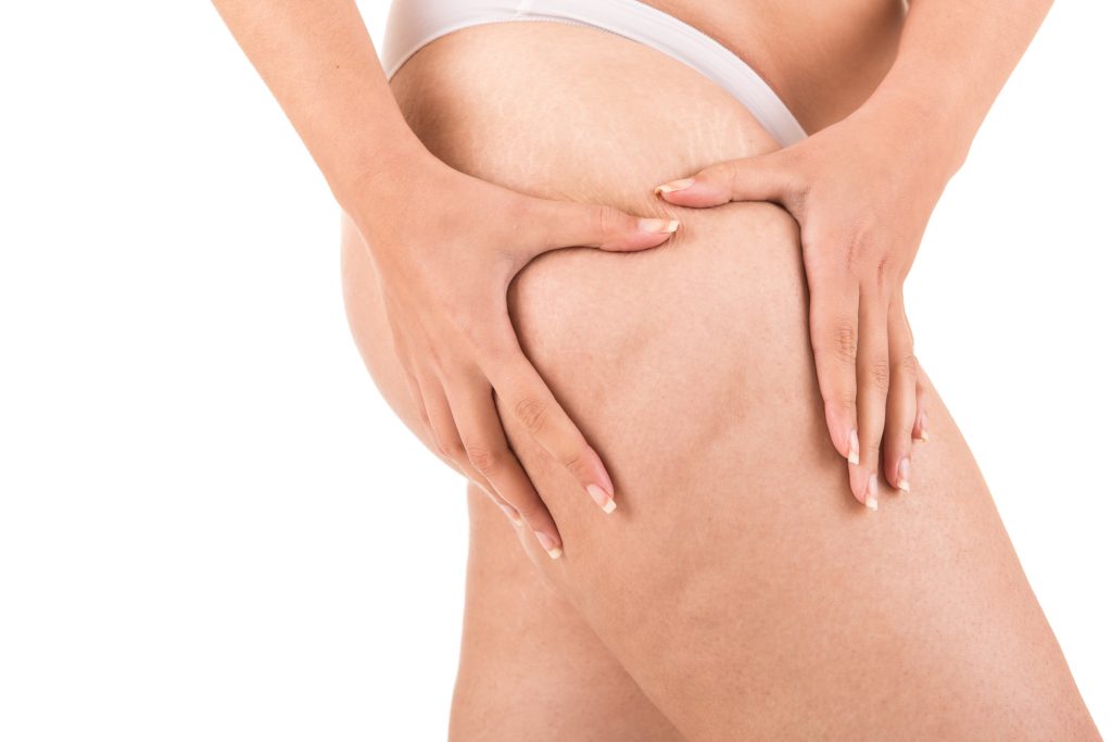 What is cellulite? What is cellulite?