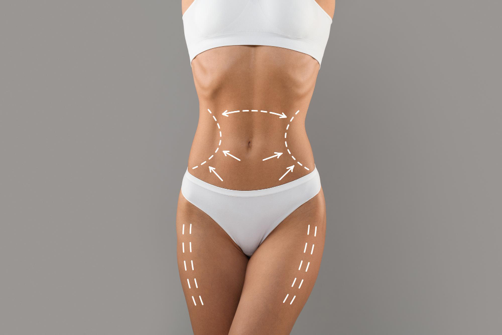Belt Lipectomy (Lower Body Lift)