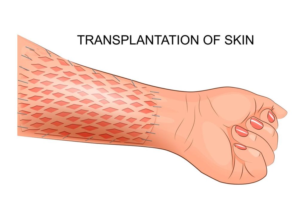 From Scar to Second Skin: How Skin Grafts Restore and Rebuild From Scar to Second Skin: How Skin Grafts Restore and Rebuild