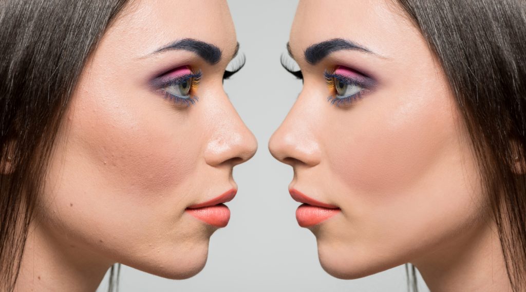 Beyond Rhinoplasty: The Magic of Alarplasty for Refining Your Nasal Profile Beyond Makeup: A Permanent Solution to Flared Nostrils with Alarplasty
