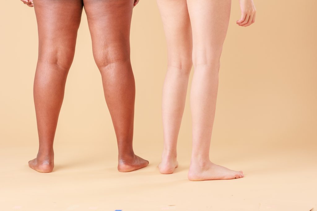 Managing Life with Lipedema and Reclaiming Your Movement Managing Life with Lipedema and Reclaiming Your Movement