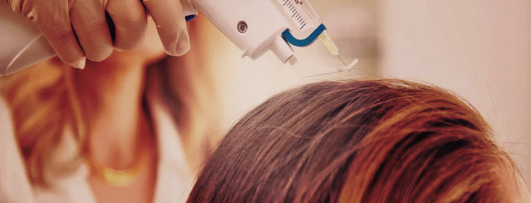 10 فوائد لعلاج تساقط الشعر بالميزوثيرابي 1 علاج تساقط الشعر بالميزوثيرابي