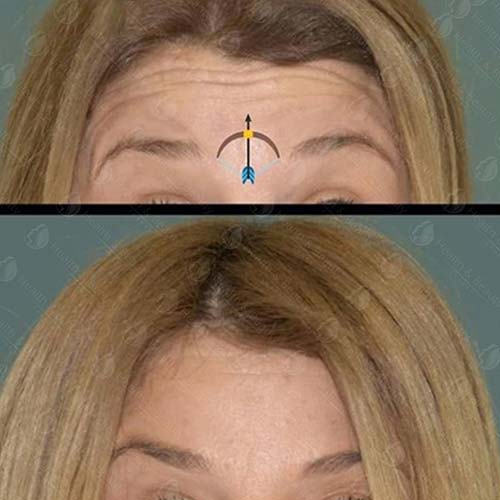 جراحة تصغير الجبهة في تركيا