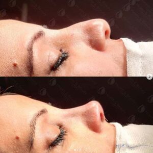 العلامات الخمس الأساسية لعملية تجميل الأنف الضعيفة أو المفرطة