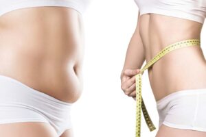 عمليات شفط الدهون